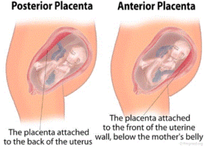Comparison between posterior and anterior placenta