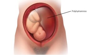 baby in womb surrounding alot of amniotic fluid in the placenta