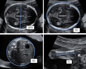 Black and white ultrasound pictures showing different measurements of measuring baby weight highlighted in blue