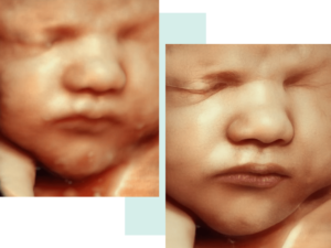 ultrasound imaging
